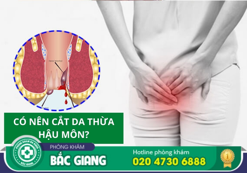 cắt da thừa hậu môn