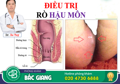 Hình ảnh áp xe hậu môn theo từng giai đoạn của bệnh