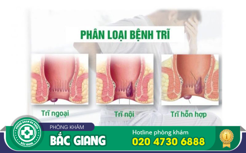 hình ảnh búi trĩ