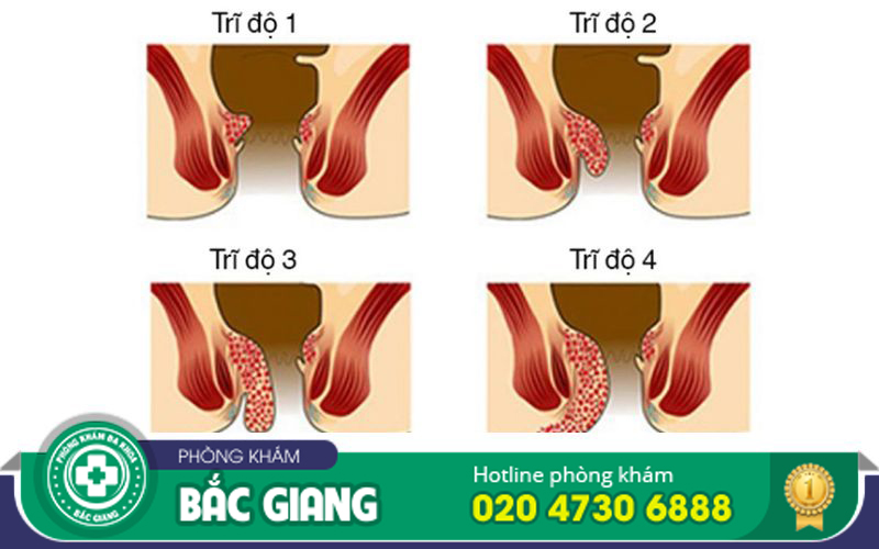 hình ảnh búi trĩ