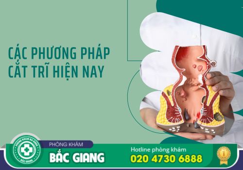 phương pháp cắt trĩ